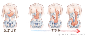 胃下垂でも太りたい 胃下垂とは 原因 症状 太り方を一挙公開 太る方法 の真実を追求する